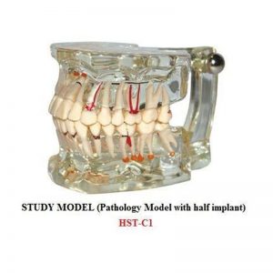 Dentcruise-Dental Study Model With Pathology And Half Implant